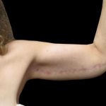 Arm Lift Before & After Patient #904