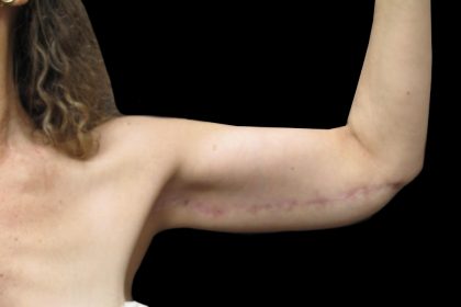 Arm Lift Before & After Patient #904