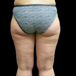 Thigh Lift Before & After Patient #3113