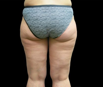 Thigh Lift Before & After Patient #3113