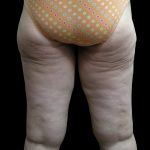 Thigh Lift Before & After Patient #3123
