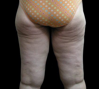 Thigh Lift Before & After Patient #3123