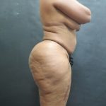 BBL / Brazilian Butt Lift / Gluteal Fat transfer Before & After Patient #1530