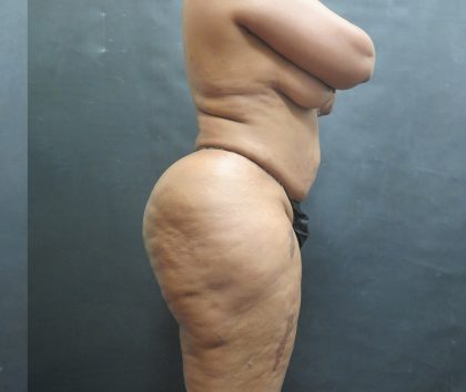 BBL / Brazilian Butt Lift / Gluteal Fat transfer Before & After Patient #1530
