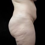 BBL / Brazilian Butt Lift / Gluteal Fat transfer Before & After Patient #1511