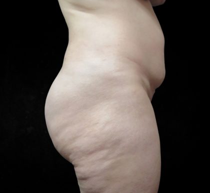 BBL / Brazilian Butt Lift / Gluteal Fat transfer Before & After Patient #1511