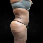BBL / Brazilian Butt Lift / Gluteal Fat transfer Before & After Patient #1490