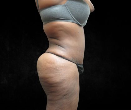 BBL / Brazilian Butt Lift / Gluteal Fat transfer Before & After Patient #1490