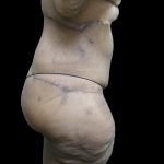Post Weight Loss Before & After Patient #2749
