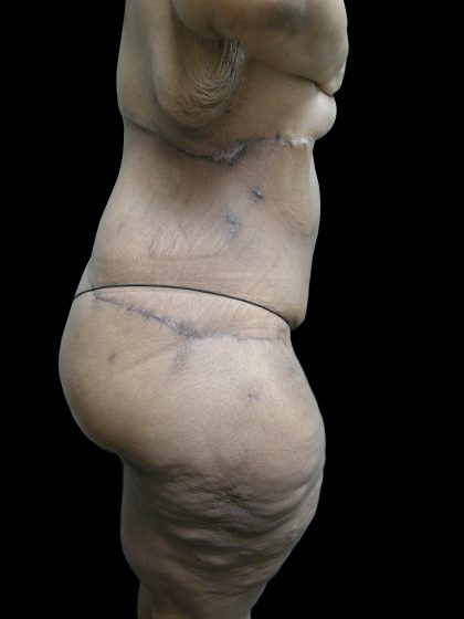 Post Weight Loss Before & After Patient #2749