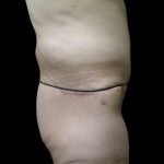 Post Weight Loss Before & After Patient #2770