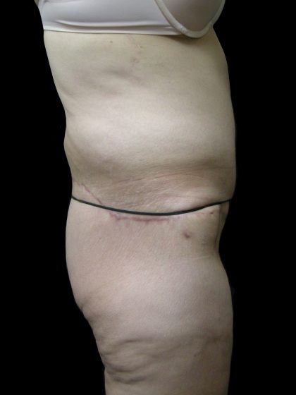 Post Weight Loss Before & After Patient #2770