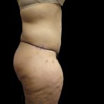 Post Weight Loss Before & After Patient #2791
