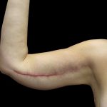 Arm Lift Before & After Patient #897