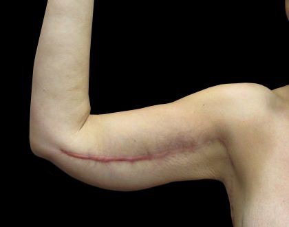 Arm Lift Before & After Patient #897