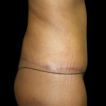 Lower Body Lift Before & After Patient #2327