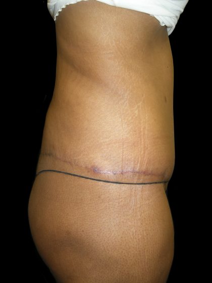 Lower Body Lift Before & After Patient #2327