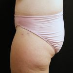 Lower Body Lift Before & After Patient #2285
