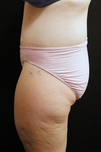 Lower Body Lift Before & After Patient #2285