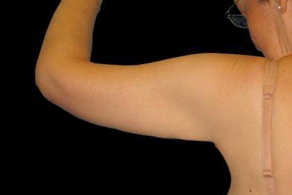 Arm Lift Before & After Patient #913