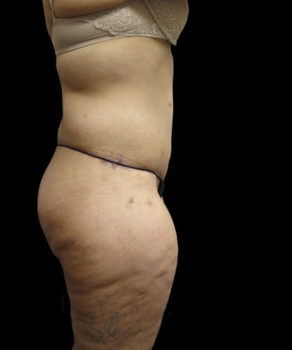 Lower Body Lift Before & After Patient #2316