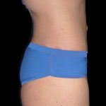 Lower Body Lift Before & After Patient #2278