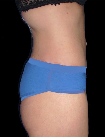 Lower Body Lift Before & After Patient #2278