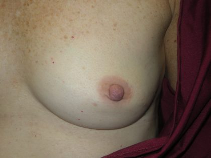 Inverted Nipple Correction Before & After Patient #1877