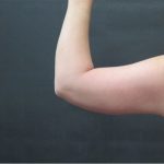 Liposuction Before & After Patient #936