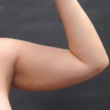 Liposuction Before & After Patient #927