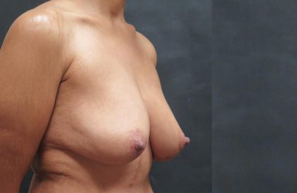 Breast Lift Before & After Patient #1244