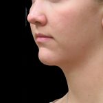 Scarless Facelift and Necklift Before & After Patient #3056
