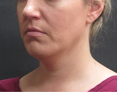 Fat Transfer Before & After Patient #1789