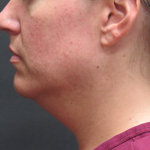 Fat Transfer Before & After Patient #1789