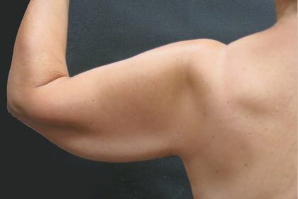 Arm Lift Before & After Patient #888