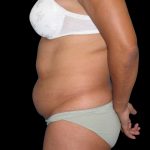 Tummy Tuck Before & After Patient #3146