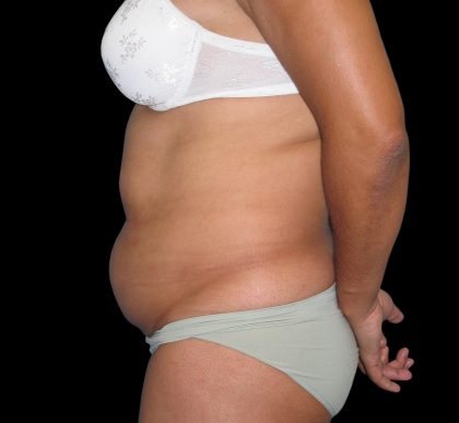 Tummy Tuck Before & After Patient #3146