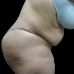Tummy Tuck Before & After Patient #3166