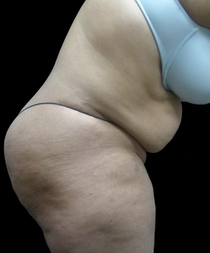 Tummy Tuck Before & After Patient #3166