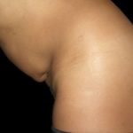 Tummy Tuck Before & After Patient #3175