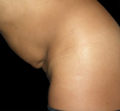 Tummy Tuck Before & After Patient #3175