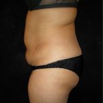Tummy Tuck Before & After Patient #3186