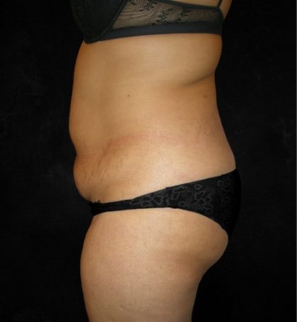 Tummy Tuck Before & After Patient #3186