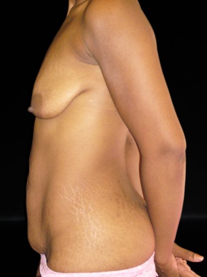 Tummy Tuck Before & After Patient #3198