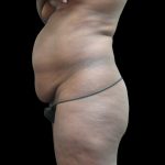 Tummy Tuck Before & After Patient #3216