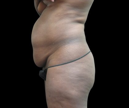 Tummy Tuck Before & After Patient #3216