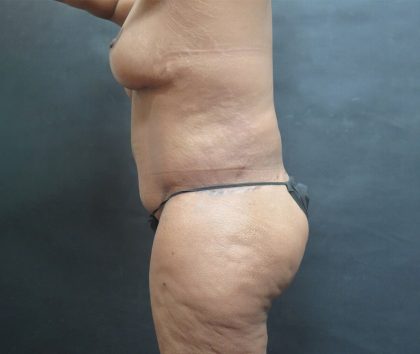 Tummy Tuck Before & After Patient #3225