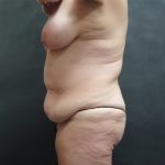 Tummy Tuck Before & After Patient #3245