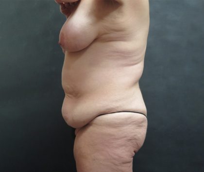 Tummy Tuck Before & After Patient #3245