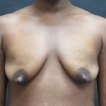 Mommy Makeover Before & After Patient #2607